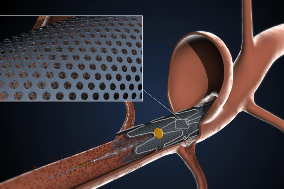 Merlin catheter deployed